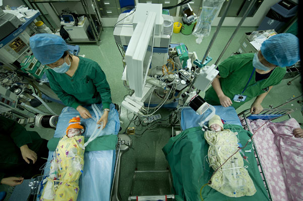 Chinese doctors separate conjoined twins